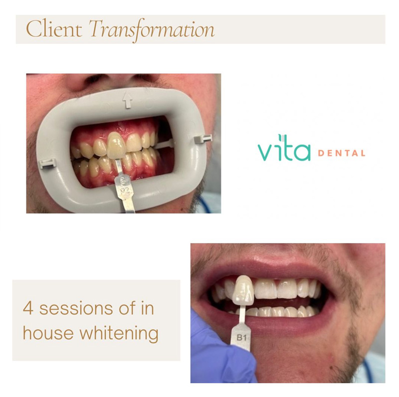 Teeth Whitening in Katy